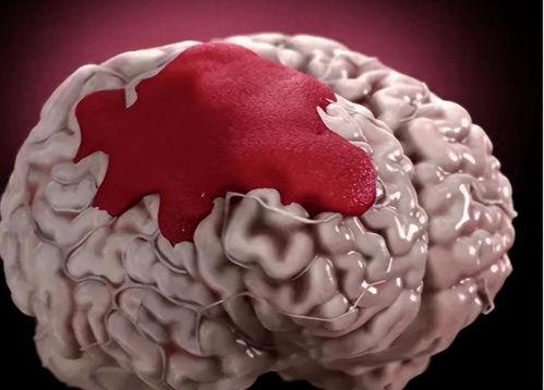 脑溢血的图片,揭秘脑部血管破裂的惊心动魄瞬间